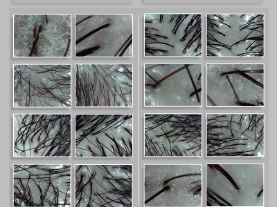Bioscalp Hair Treatment